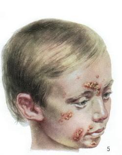 стрептококове impetigo