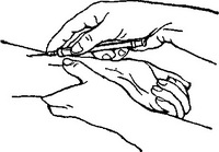 внутрішньошкірна ін'єкція