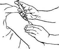 підшкірна ін'єкція