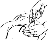 внутрішньом'язова ін'єкція