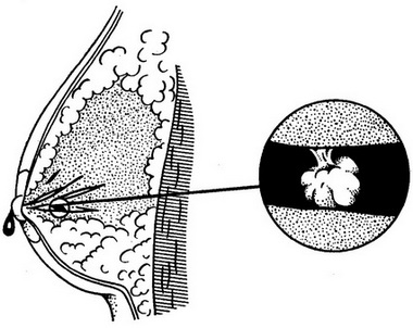интрадуктальная папілома