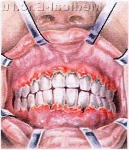 виразковий гінгівіт