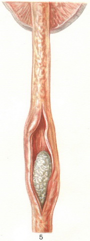 камінь у сечоводі