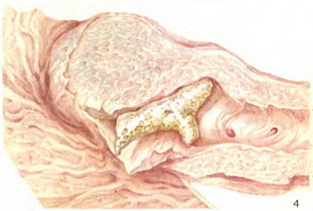 камені підшлункової залози