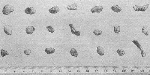 камені сечоводів