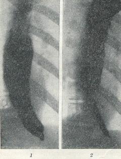 кардіоспазм