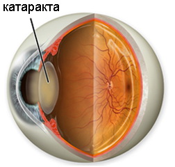 помутніння кришталика