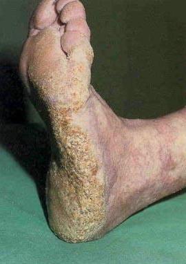 кератодермия підошви