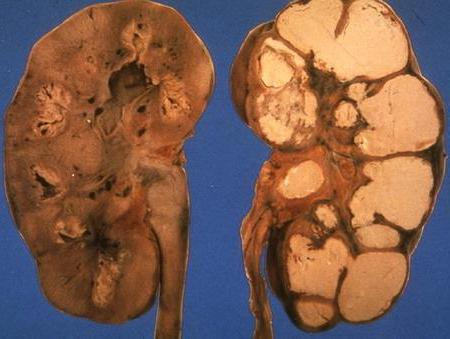 туберкульоз нирки