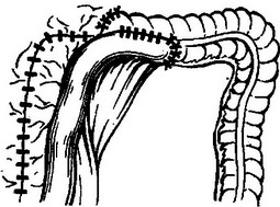 илеотрансверзостомия