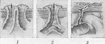 кишкові свищі