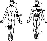 накладення вологих компресів