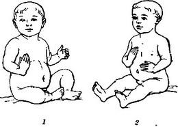 вроджена косорукість
