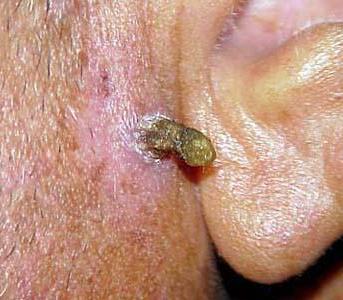 шкірний ріг