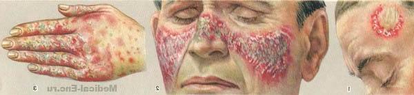 червоний вовчак