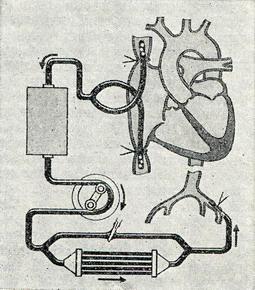 схема штучного кровообігу