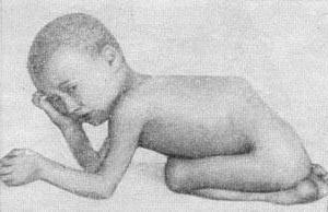 кутовий кіфоз