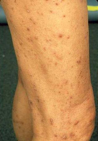 хвороба Кирле