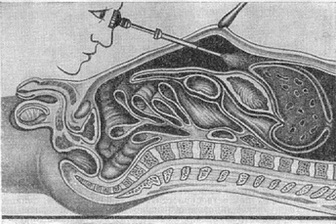 лапароскопія