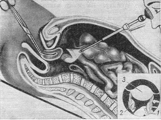 огляд органів малого тазу