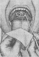 непряма ларингоскопія