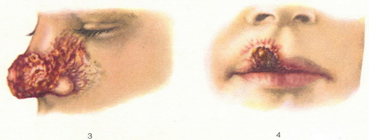 міський шкірний лейшманіоз