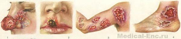 шкірний лейшманіоз