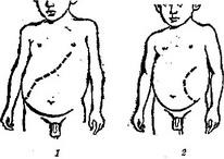 вісцеральний лейшманіоз