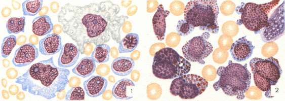 пунктат кісткового мозку хворого гемоцитобластозом