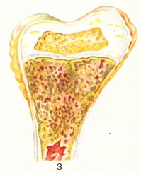 гострий гемоцитобластоз