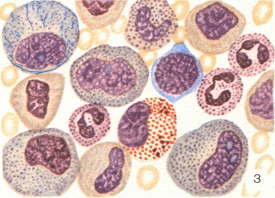 периферична кров при хронічному мієлолейкозі