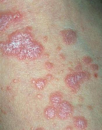 червоний плоский лишай