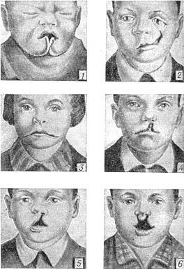 вроджені дефекти особи