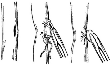 пристінкові лігатура відня