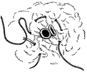 обколювання судини