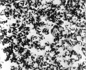 злоякісна лимфангиоэндотелиома