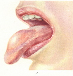 ліпома мови