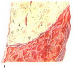 крупозна пневмонія