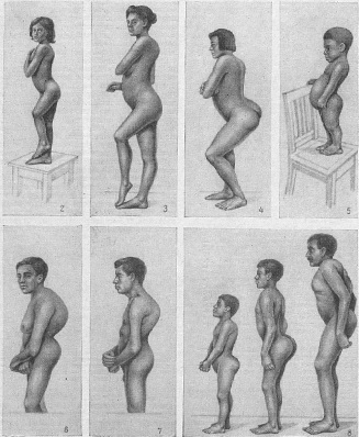 компенсаторно посилений поперековий лордоз