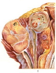 лімфаденіт шийних лімфатичних вузлів при септичній скарлатині