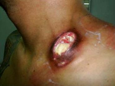 лімфаденіт