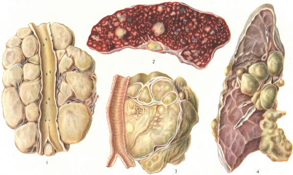 лімфогранулематоз