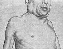 лімфогранулематоз