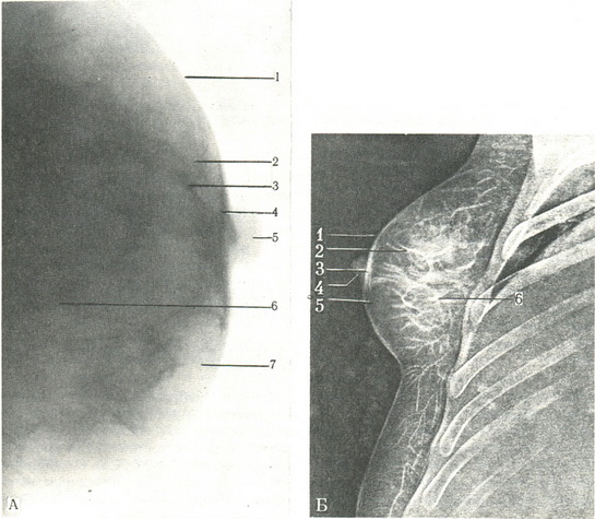 рентгенограма і электронограмма молочної залози в бічній проекції