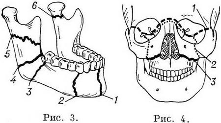переломи нижньої щелепи