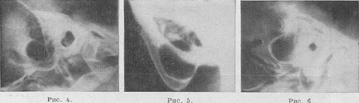 mastoiditis roentgen