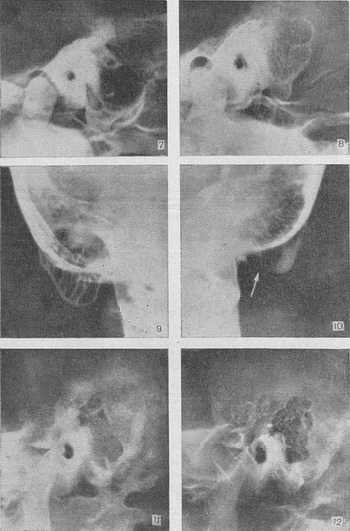 гострий мастоїдит рентген