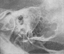 рентгенограма скроневої кістки