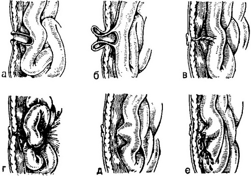 патологія дивертикула Меккеля