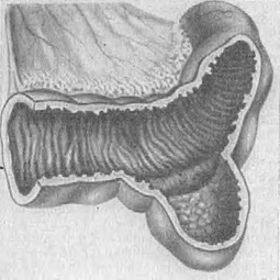 дивертикул Меккеля
